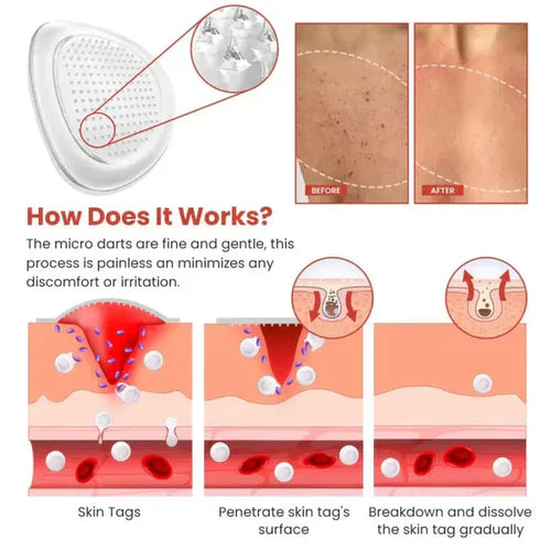 Derma Smooth Skin Tag Removal Patch - 72 Patches