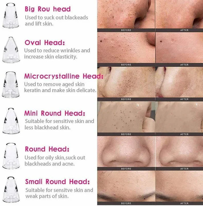 Acne Pore Cleaner & Black Head Remover